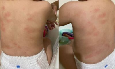 mae-denuncia-creche-municipal-de-cuiaba-apos-ver-hematomas-em-bebe